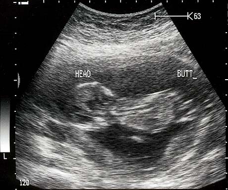 Baby Butt Sonogram