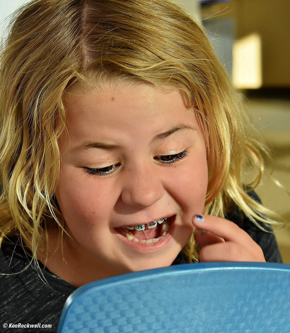 Katie gets braces